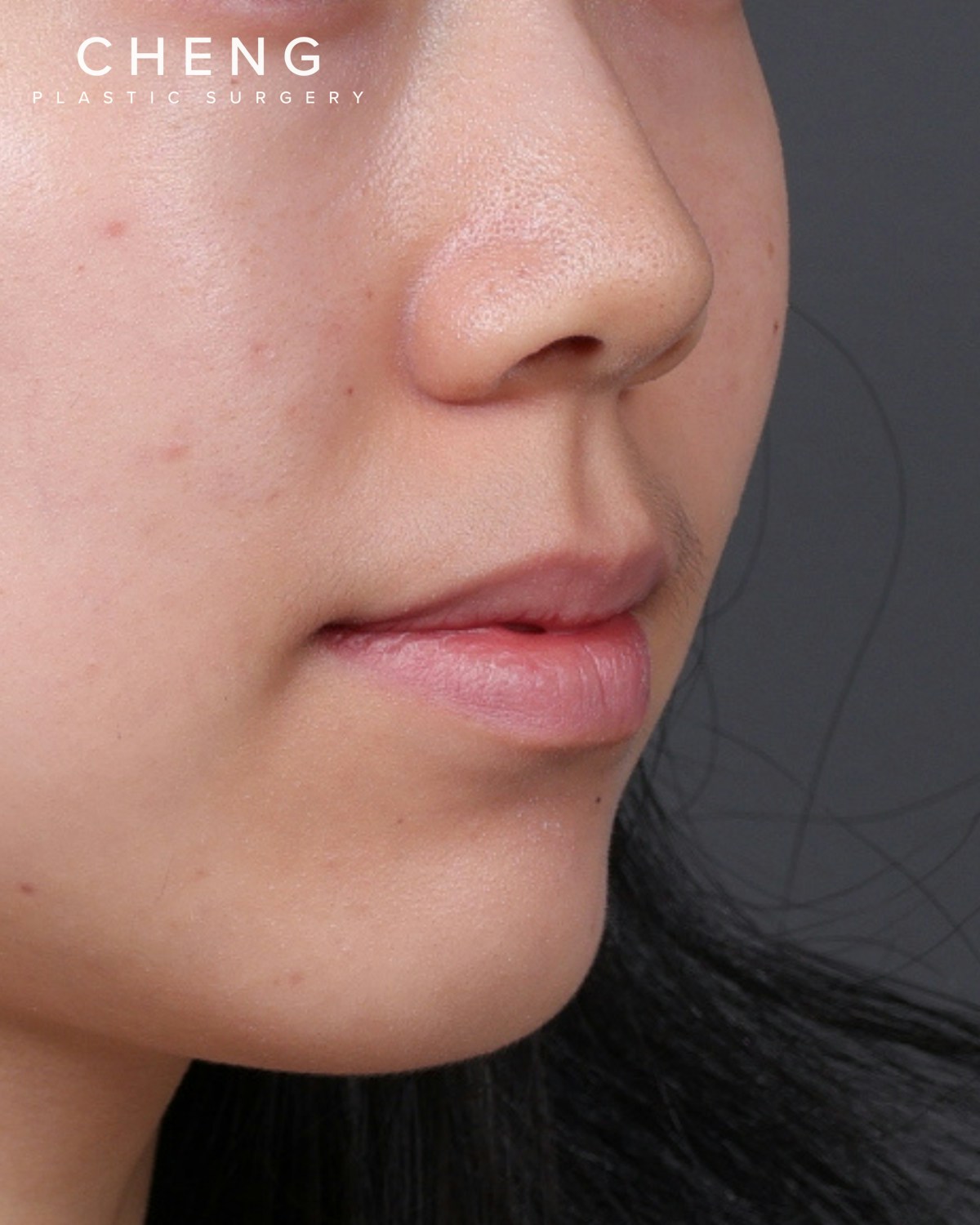 Dermal Fillers Before & After Gallery - Patient 377909 - Image 3