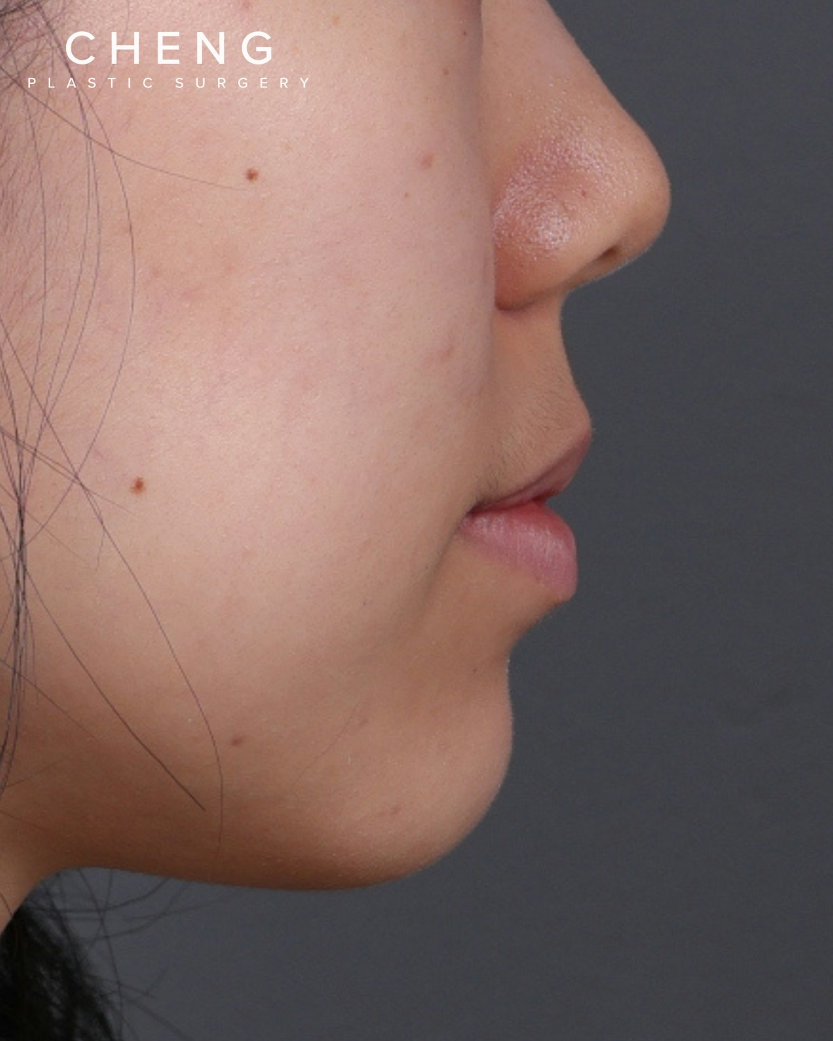 Dermal Fillers Before & After Gallery - Patient 377909 - Image 5