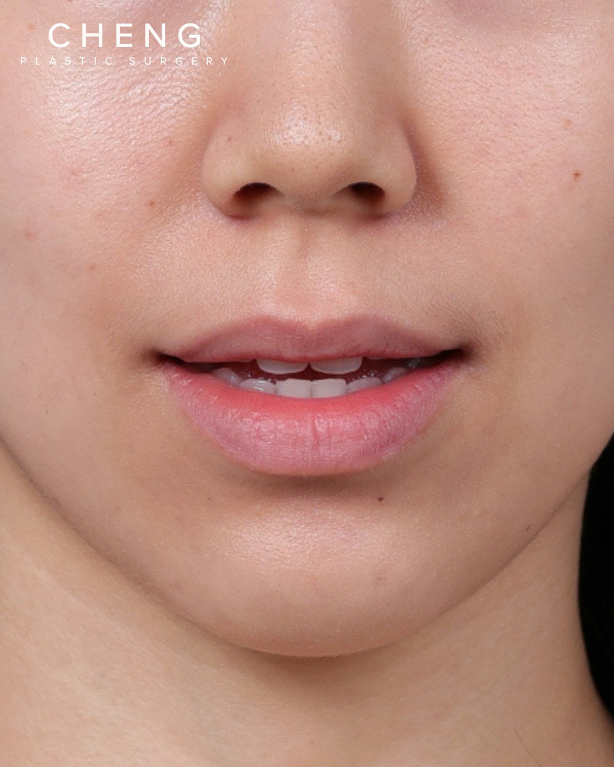Dermal Fillers Before & After Gallery - Patient 377909 - Image 1