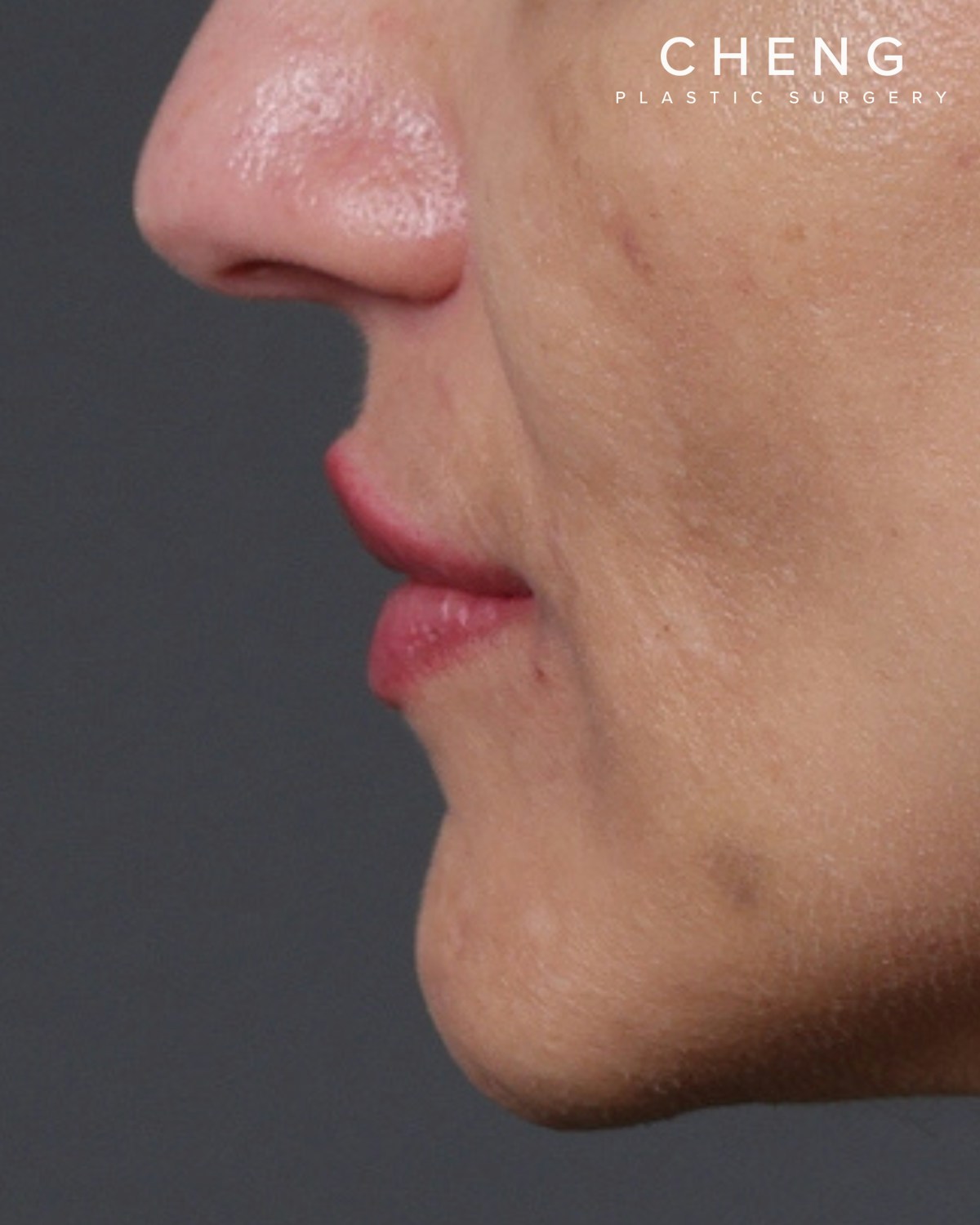 Dermal Fillers Before & After Gallery - Patient 119274 - Image 6