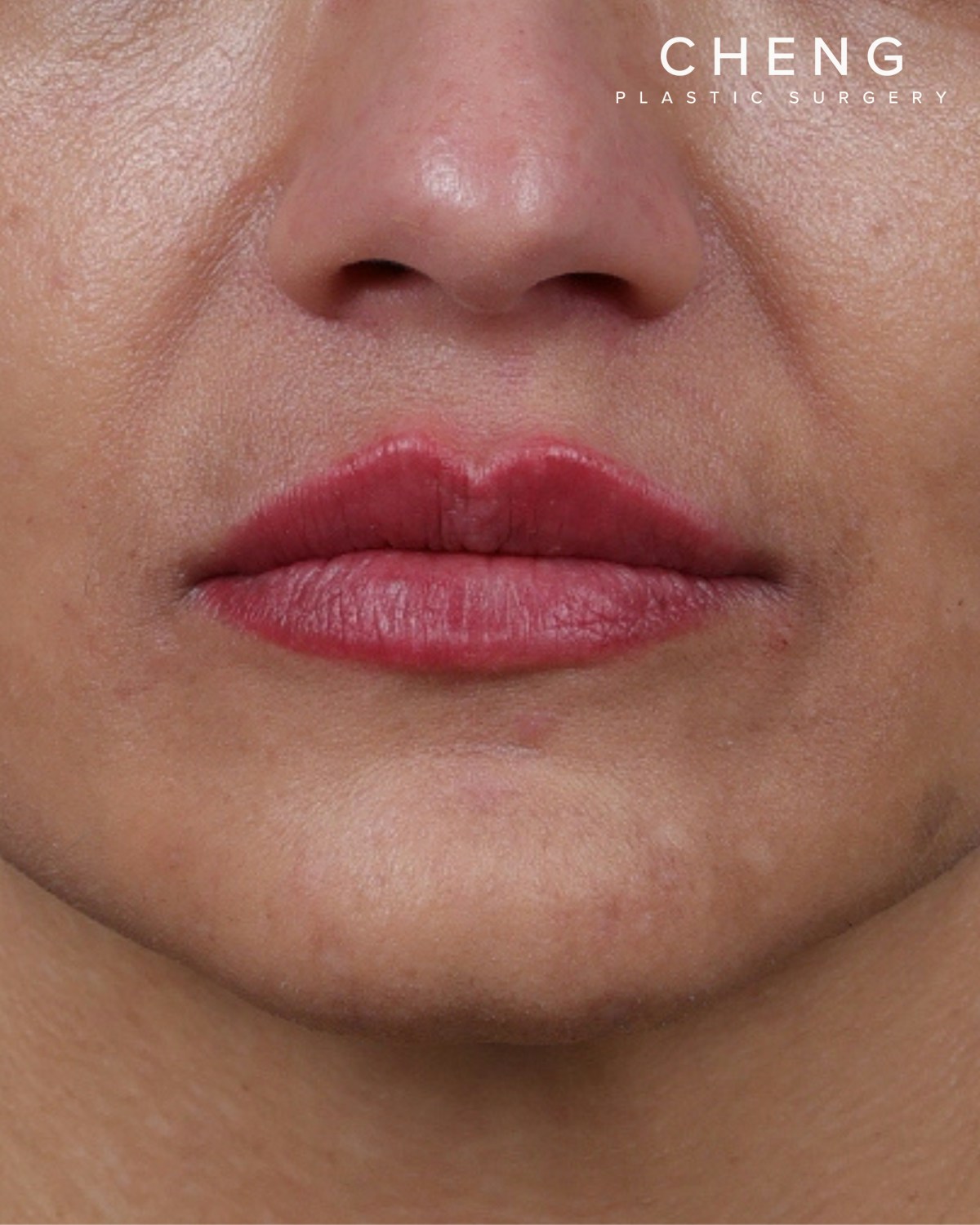Dermal Fillers Before & After Gallery - Patient 119274 - Image 2
