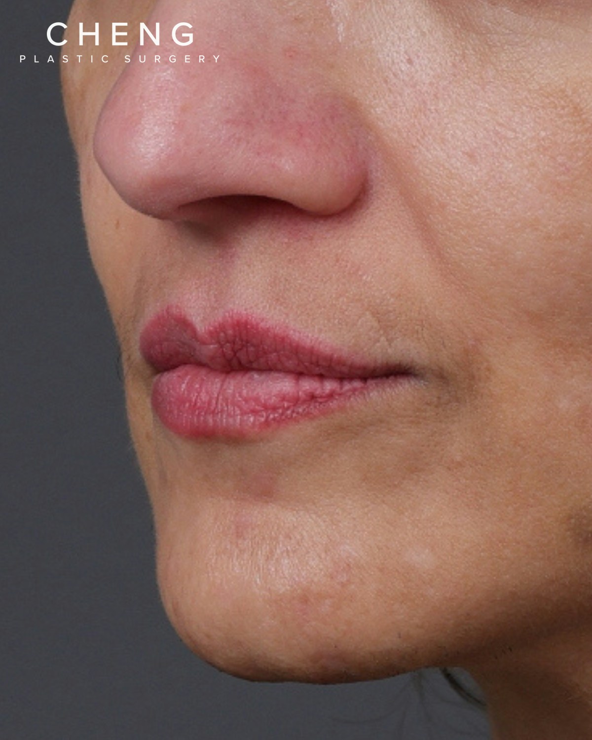 Dermal Fillers Before & After Gallery - Patient 119274 - Image 3