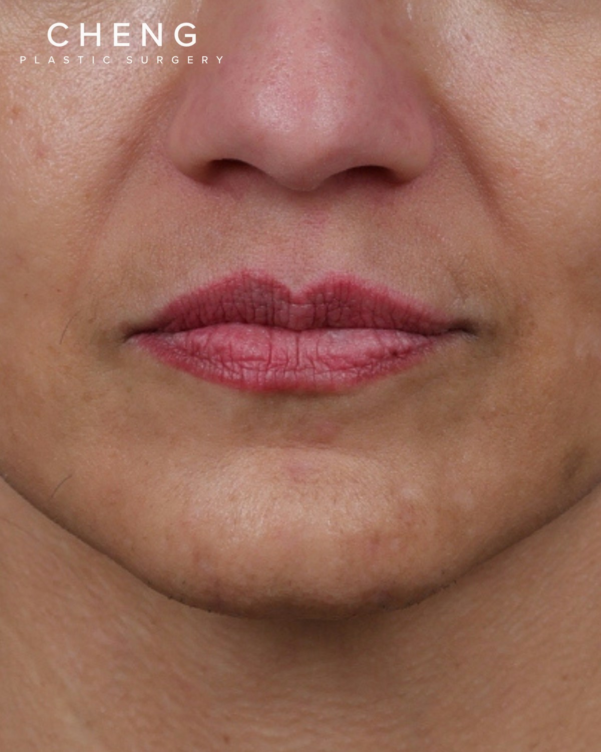 Dermal Fillers Before & After Gallery - Patient 119274 - Image 1
