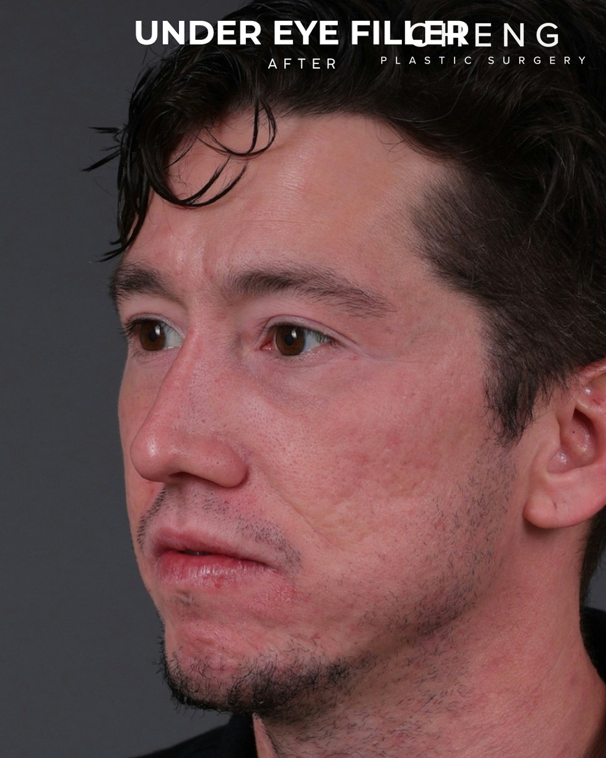 Dermal Fillers Before & After Gallery - Patient 934032 - Image 6