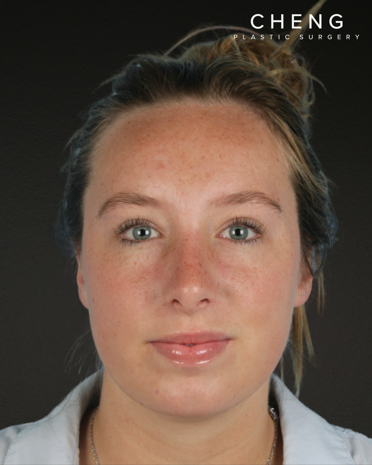 Rhinoplasty Before & After Gallery - Patient 356462 - Image 4