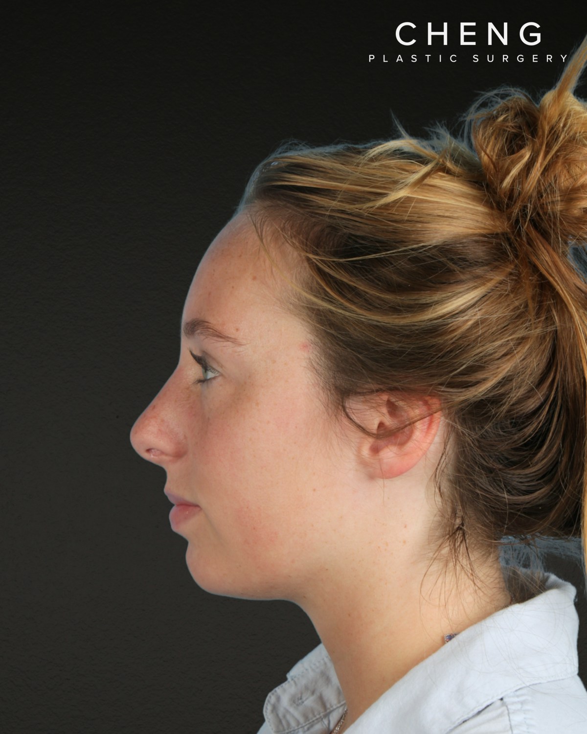 Rhinoplasty Before & After Gallery - Patient 356462 - Image 10