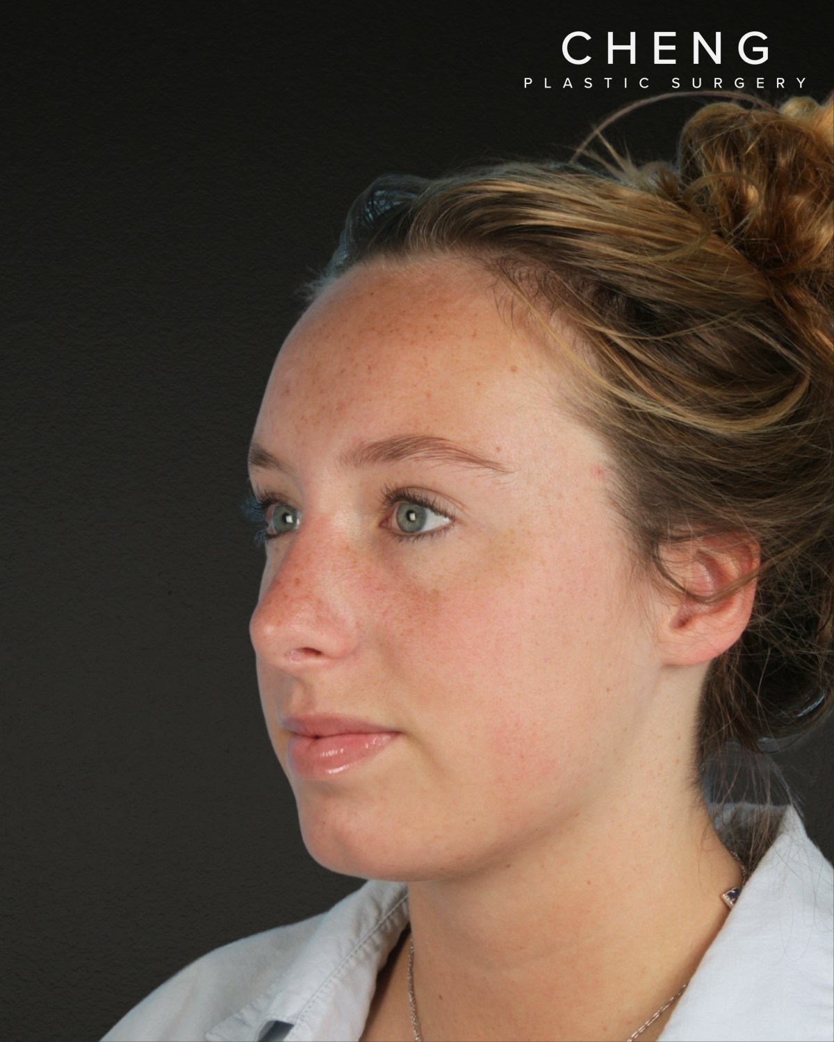 Rhinoplasty Before & After Gallery - Patient 356462 - Image 6