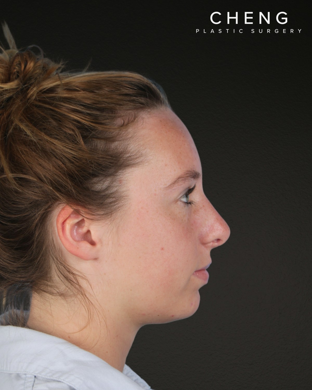 Rhinoplasty Before & After Gallery - Patient 356462 - Image 2