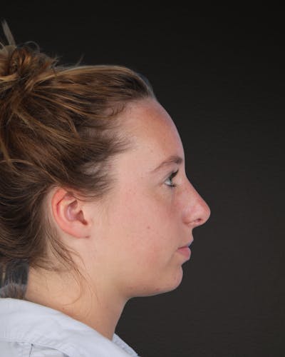 Rhinoplasty Before & After Gallery - Patient 356462 - Image 2