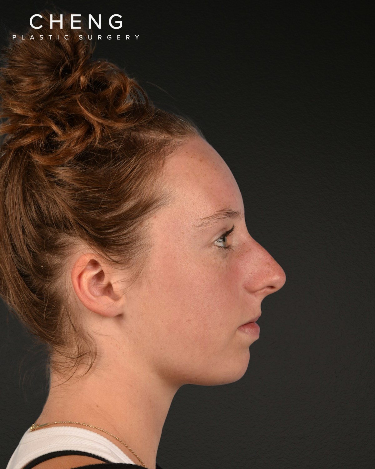 Rhinoplasty Before & After Gallery - Patient 356462 - Image 1