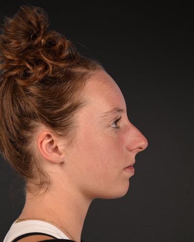 Rhinoplasty Before & After Gallery - Patient 356462 - Image 1