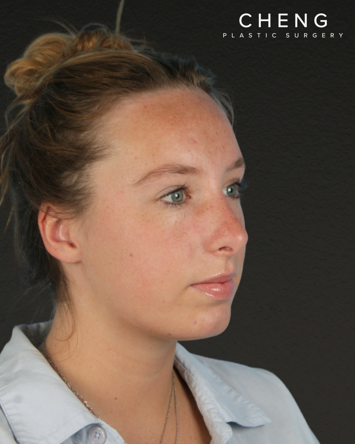 Rhinoplasty Before & After Gallery - Patient 356462 - Image 8