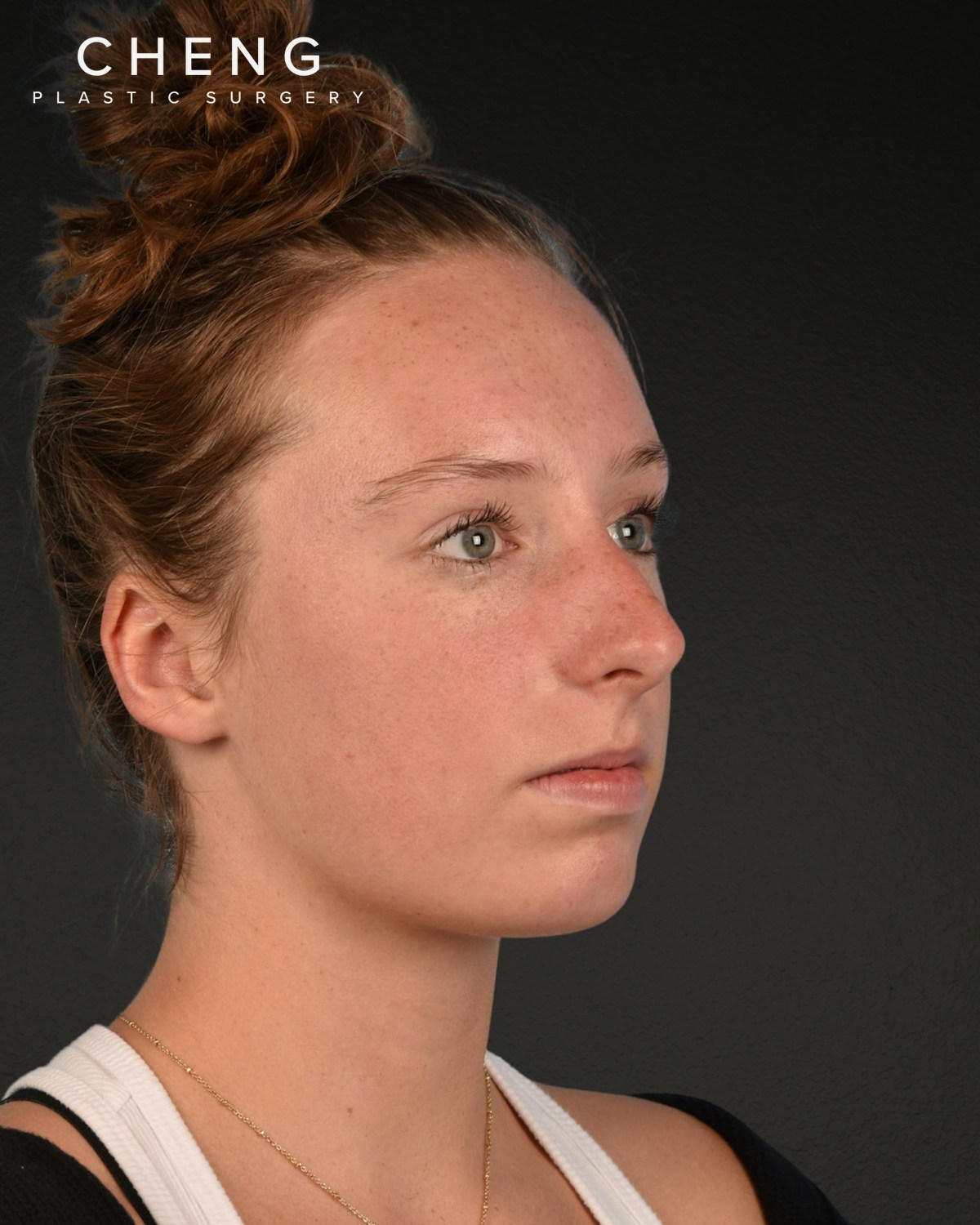 Rhinoplasty Before & After Gallery - Patient 356462 - Image 7