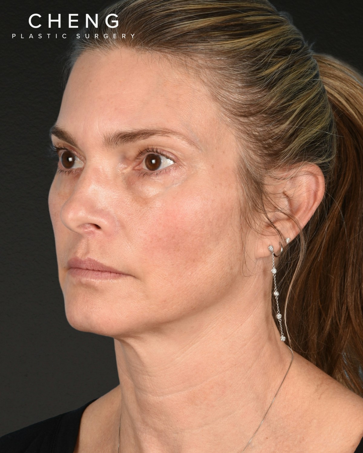 Facelift Before & After Gallery - Patient 127422 - Image 3