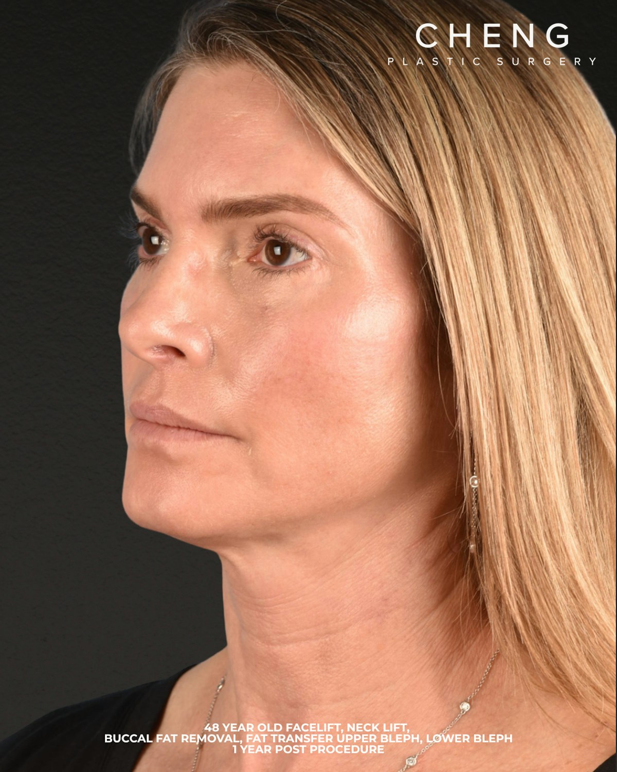Facelift Before & After Gallery - Patient 127422 - Image 4