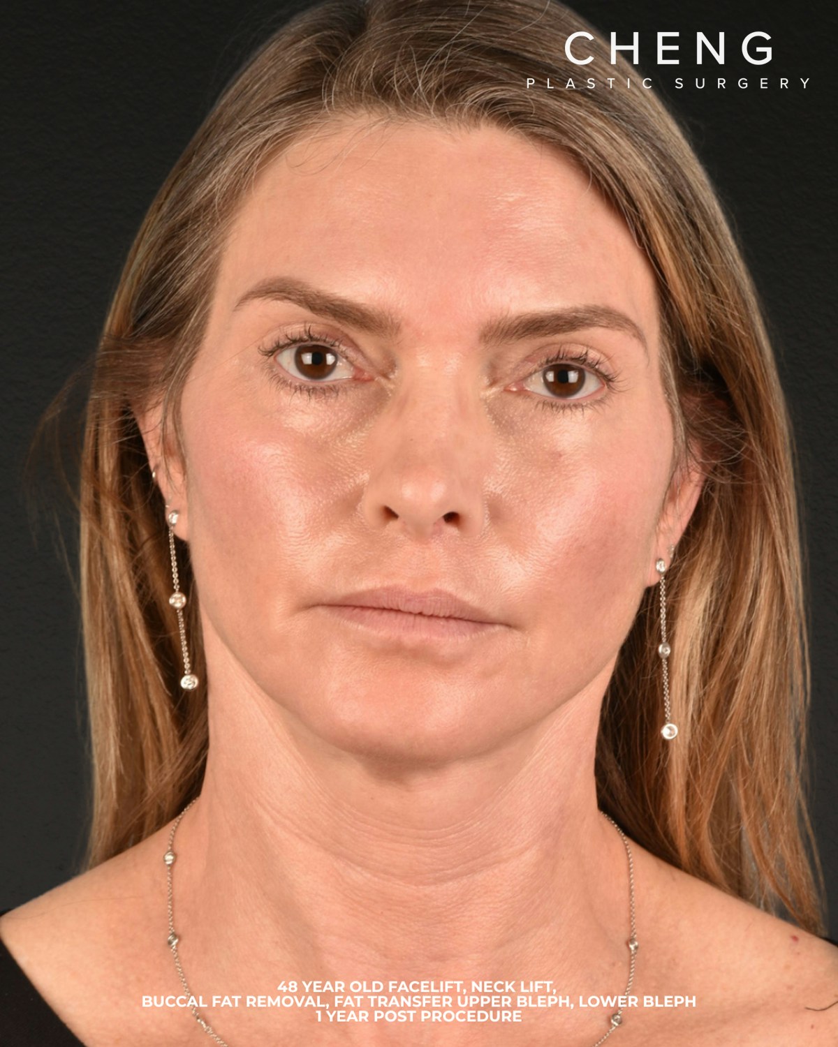 Facelift Before & After Gallery - Patient 127422 - Image 2