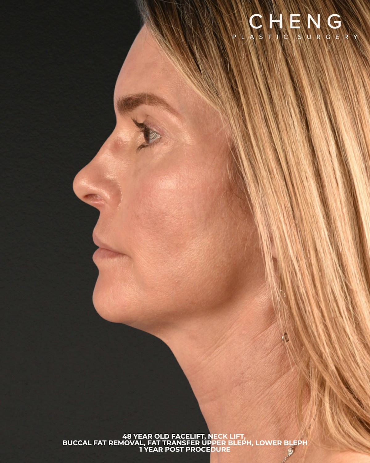 Facelift Before & After Gallery - Patient 127422 - Image 6