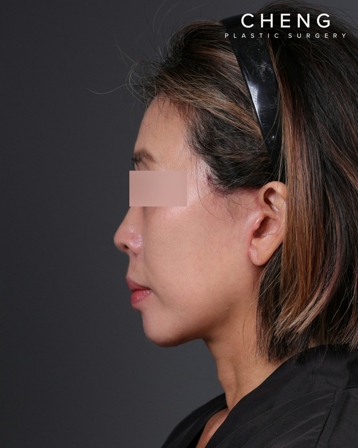 Facelift Before & After Gallery - Patient 178633 - Image 10