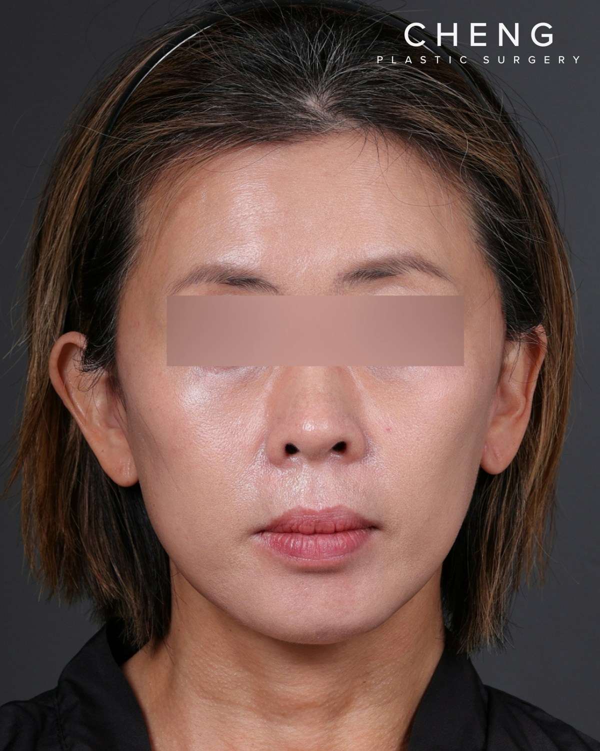 Facelift Before & After Gallery - Patient 178633 - Image 6