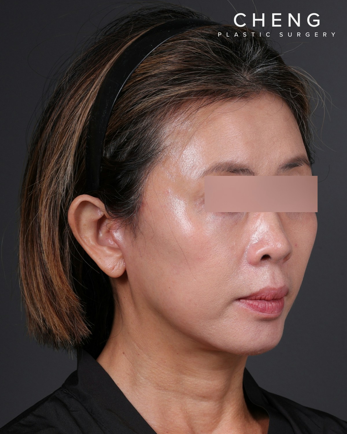 Facelift Before & After Gallery - Patient 178633 - Image 4