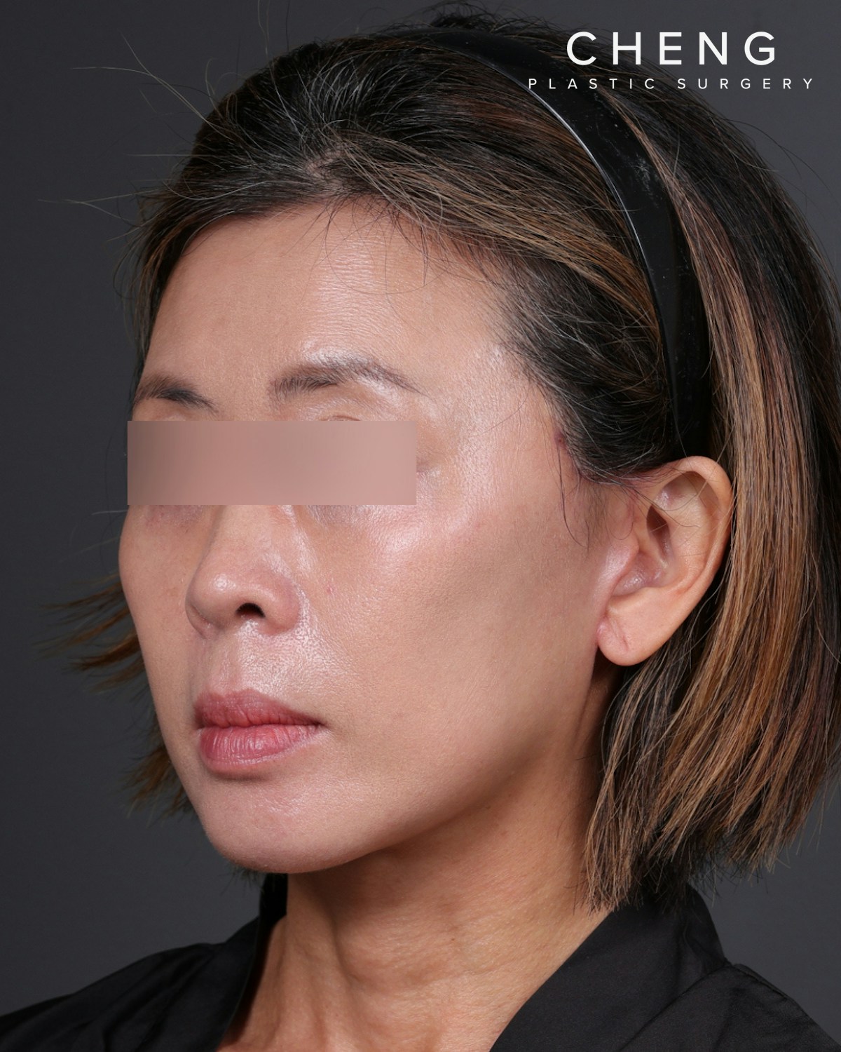 Facelift Before & After Gallery - Patient 178633 - Image 8