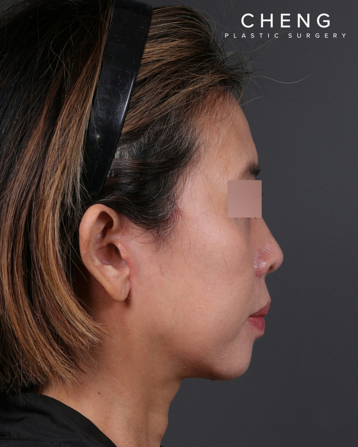 Facelift Before & After Gallery - Patient 178633 - Image 2