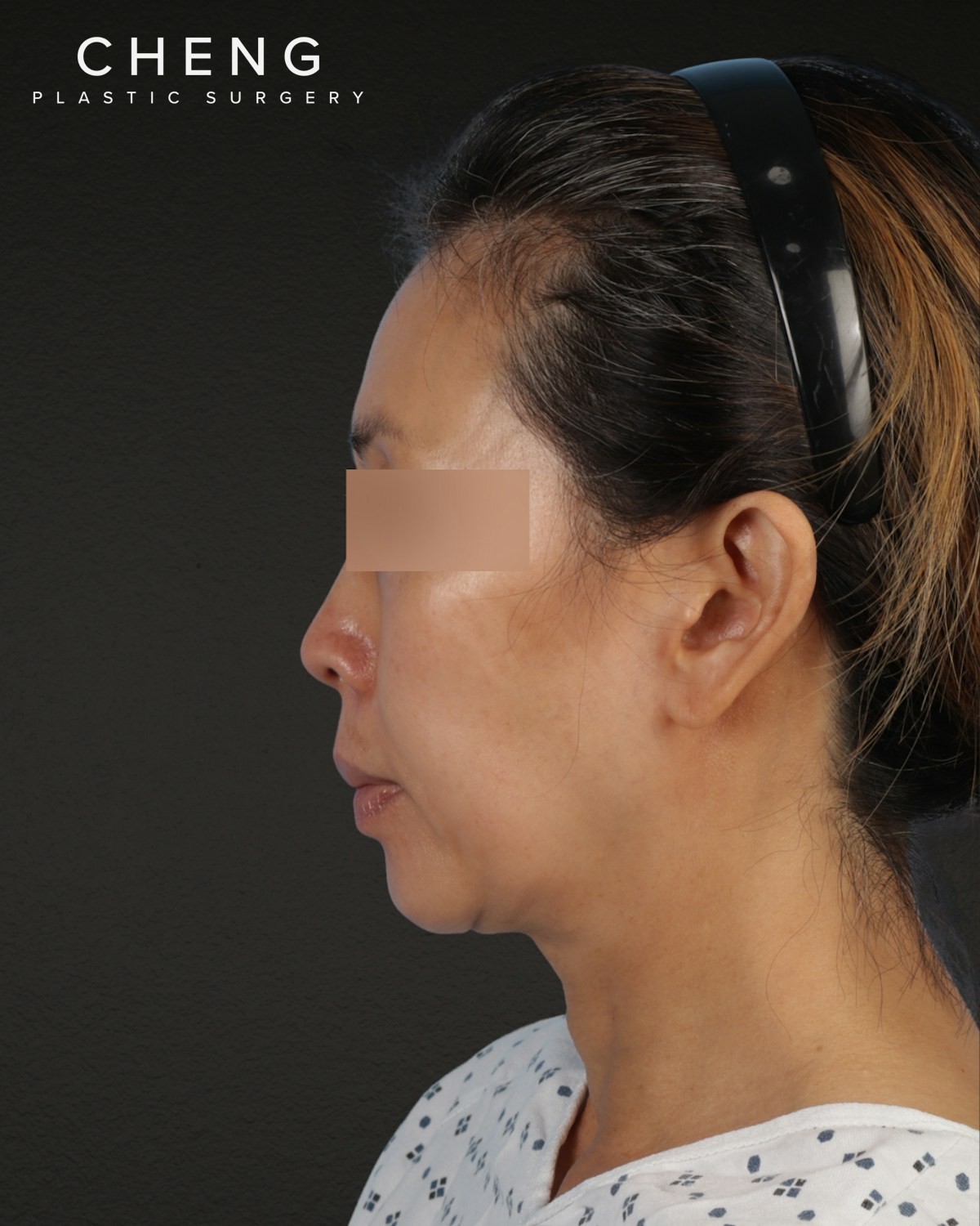 Facelift Before & After Gallery - Patient 178633 - Image 9