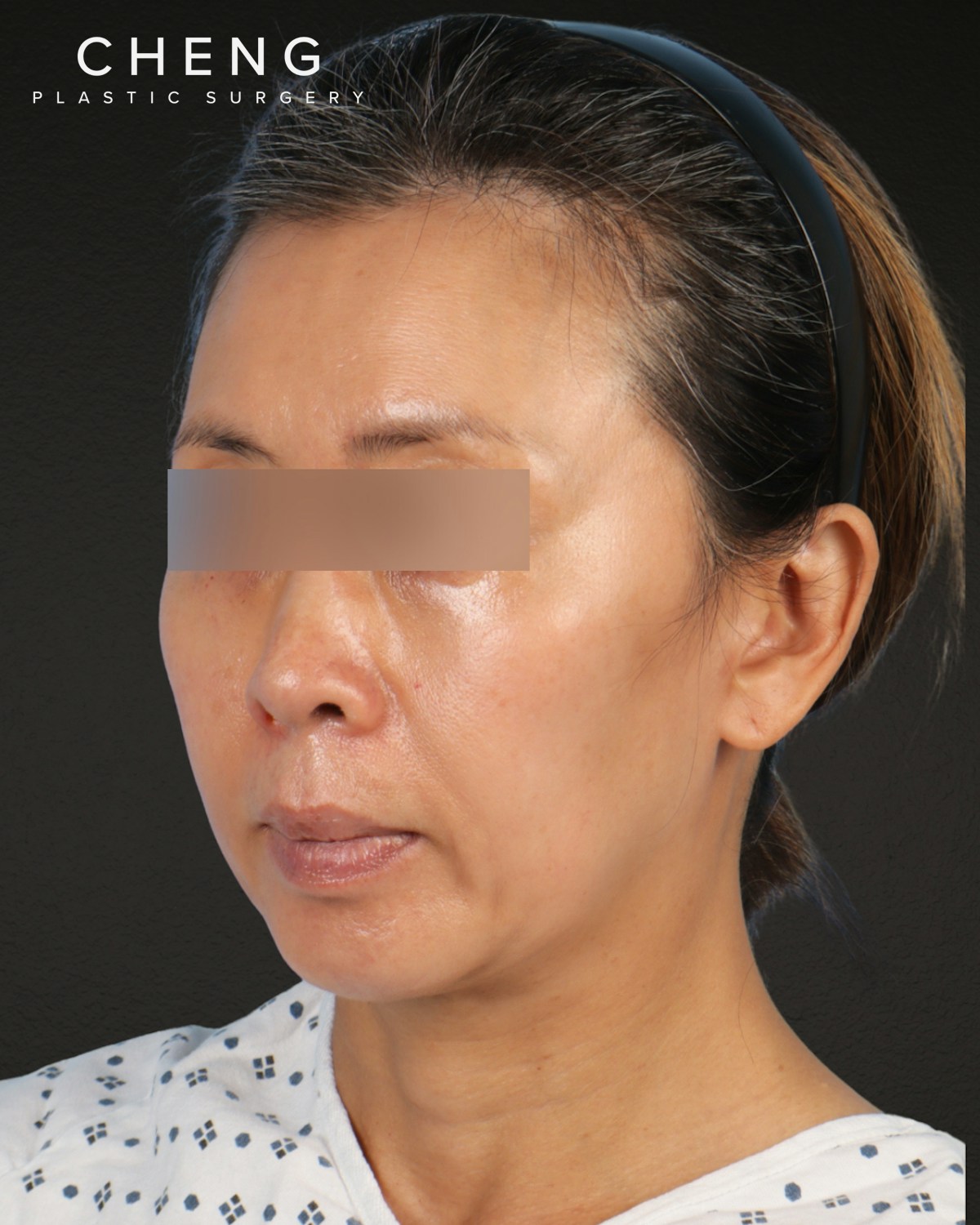 Facelift Before & After Gallery - Patient 178633 - Image 7