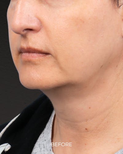 Ultherapy Before & After Gallery - Patient 134958 - Image 1