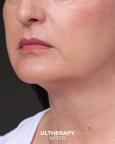 Ultherapy Before & After Gallery - Patient 134958 - Image 2