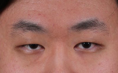 Blepharoplasty Before & After Gallery - Patient 402892 - Image 1