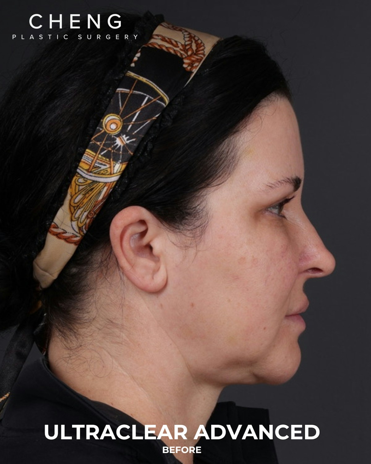 UltraClear Before & After Gallery - Patient 223793 - Image 11