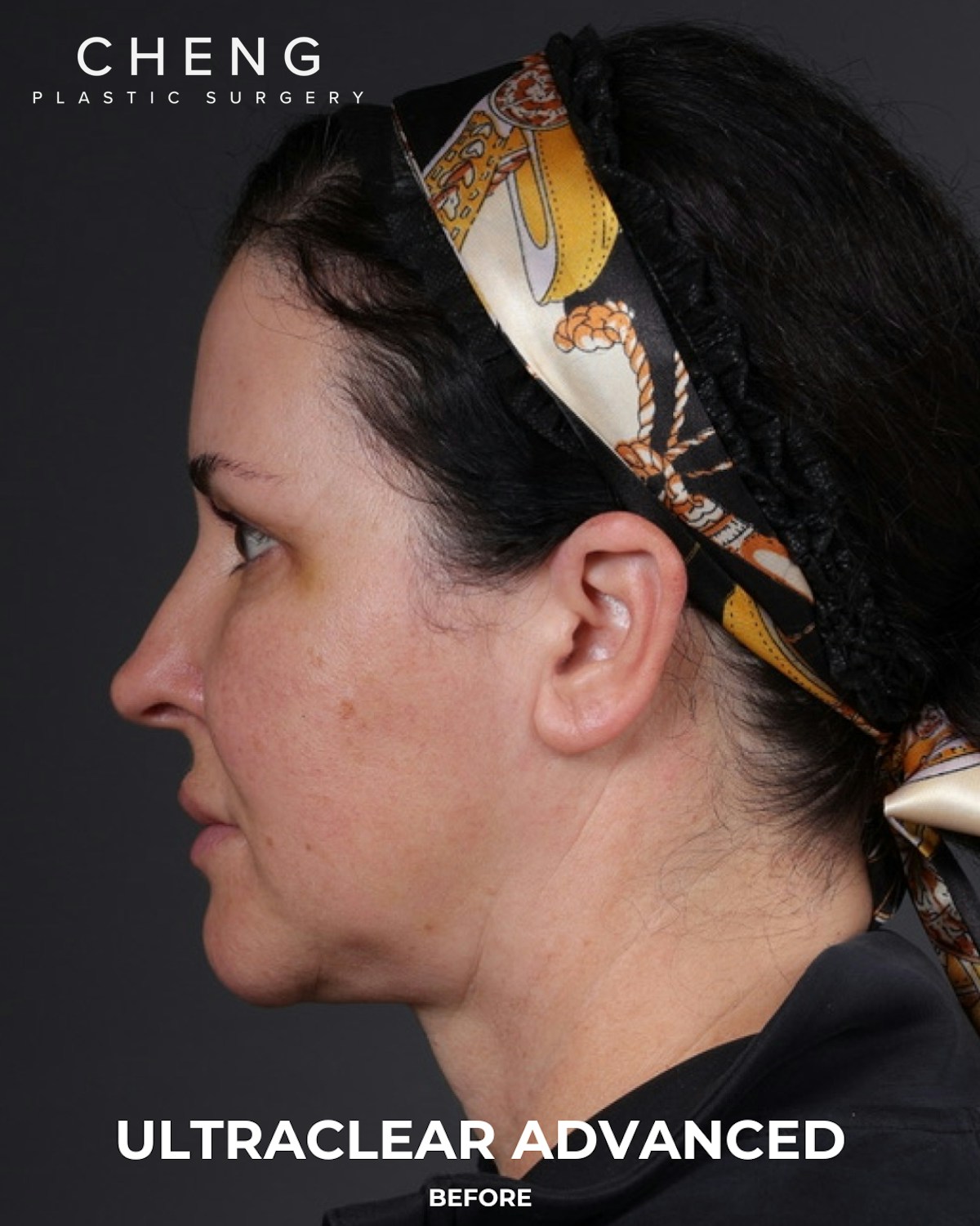 UltraClear Before & After Gallery - Patient 223793 - Image 13