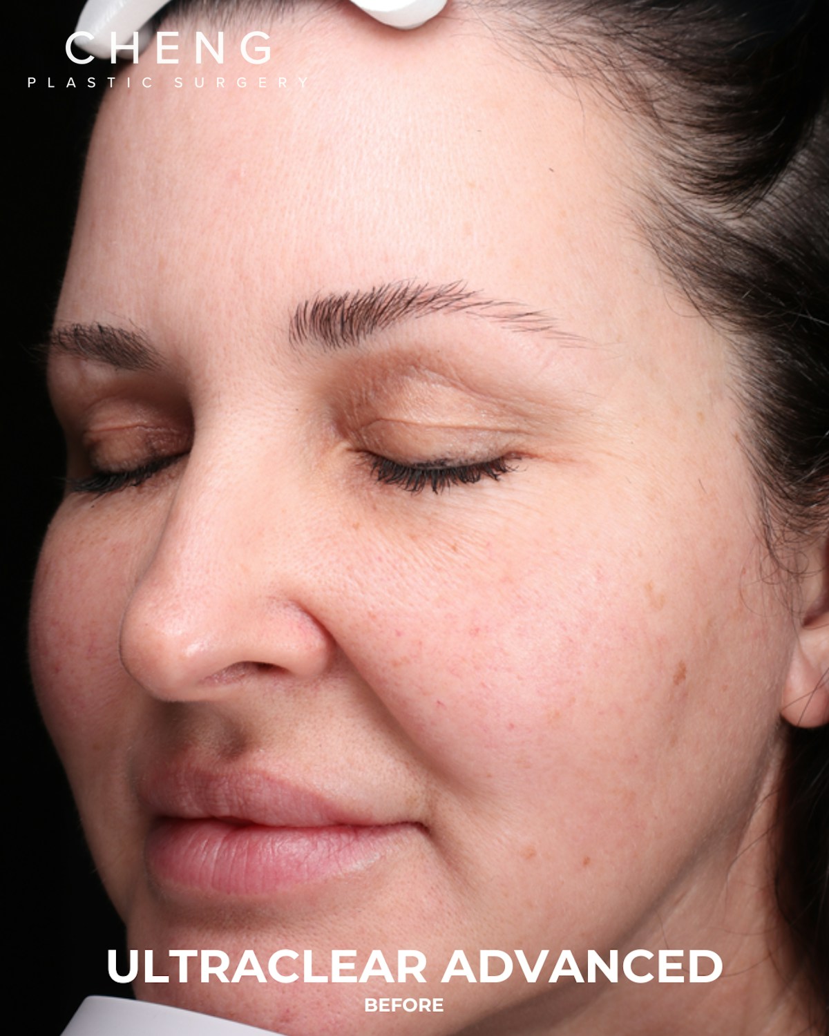 UltraClear Before & After Gallery - Patient 223793 - Image 5