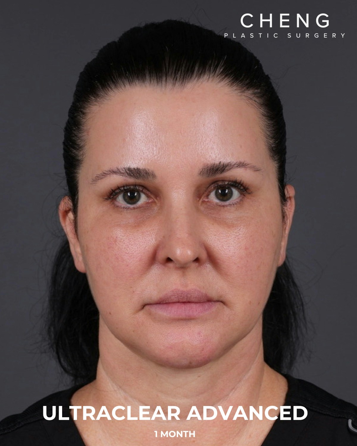 UltraClear Before & After Gallery - Patient 223793 - Image 8