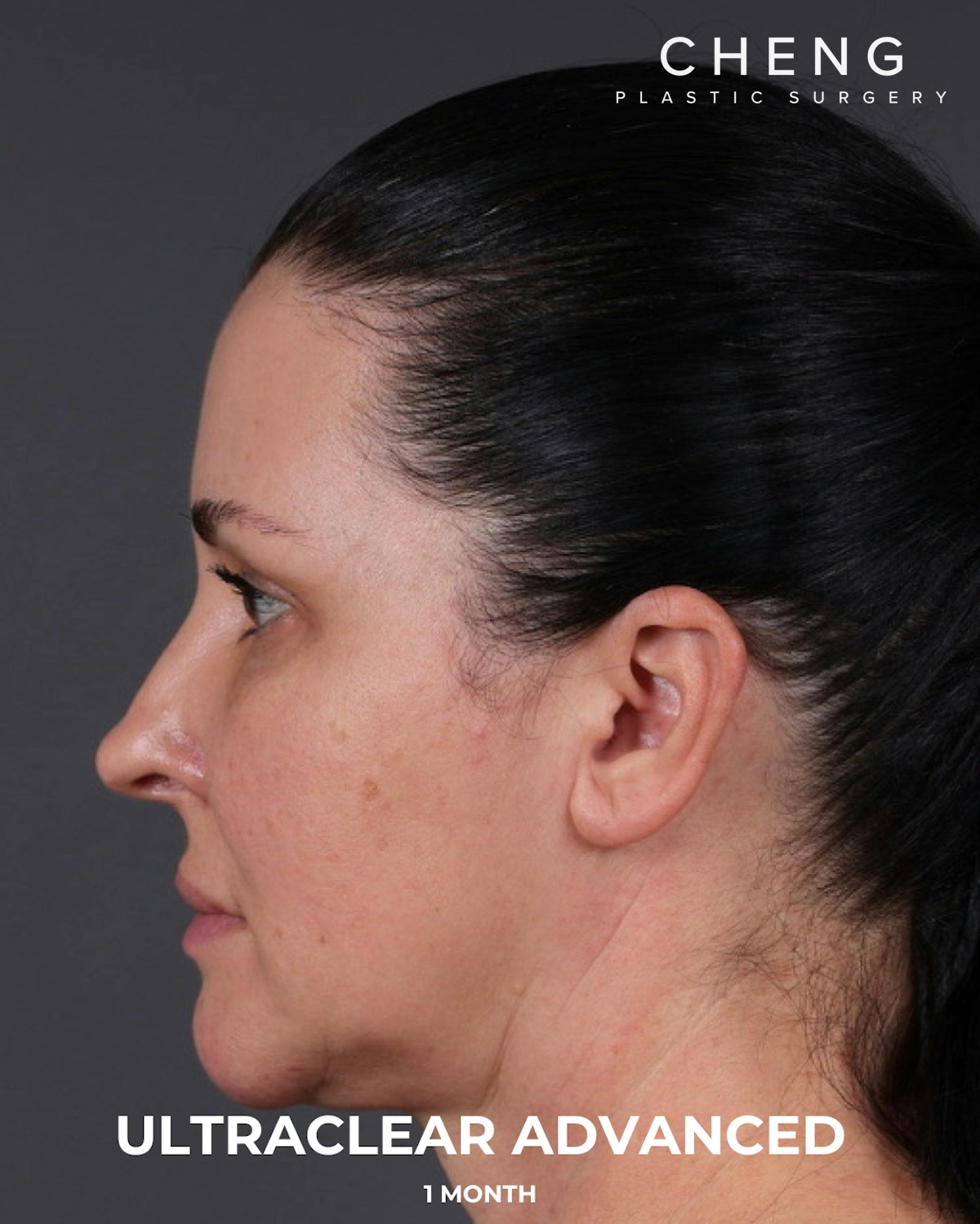 UltraClear Before & After Gallery - Patient 223793 - Image 14