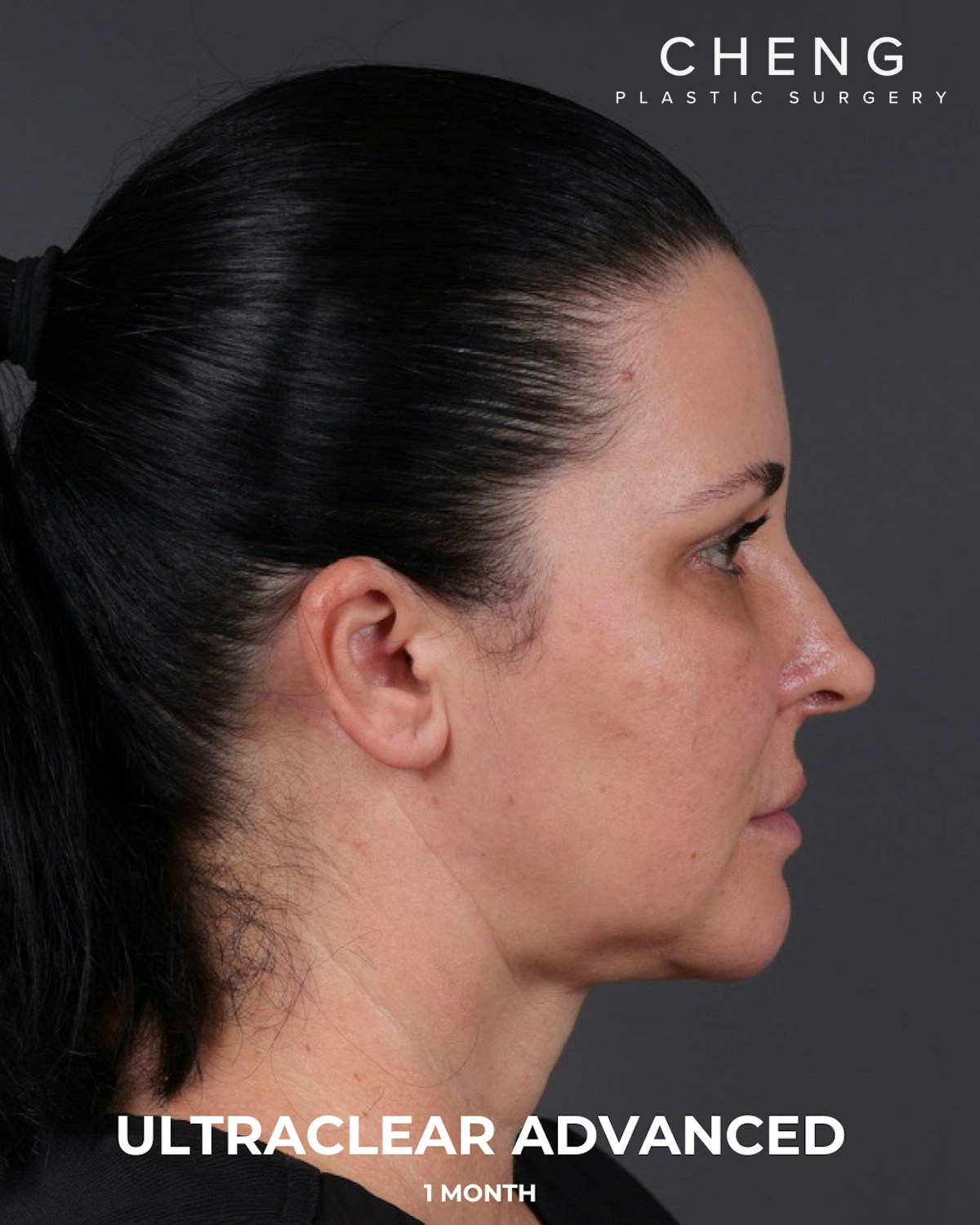UltraClear Before & After Gallery - Patient 223793 - Image 12