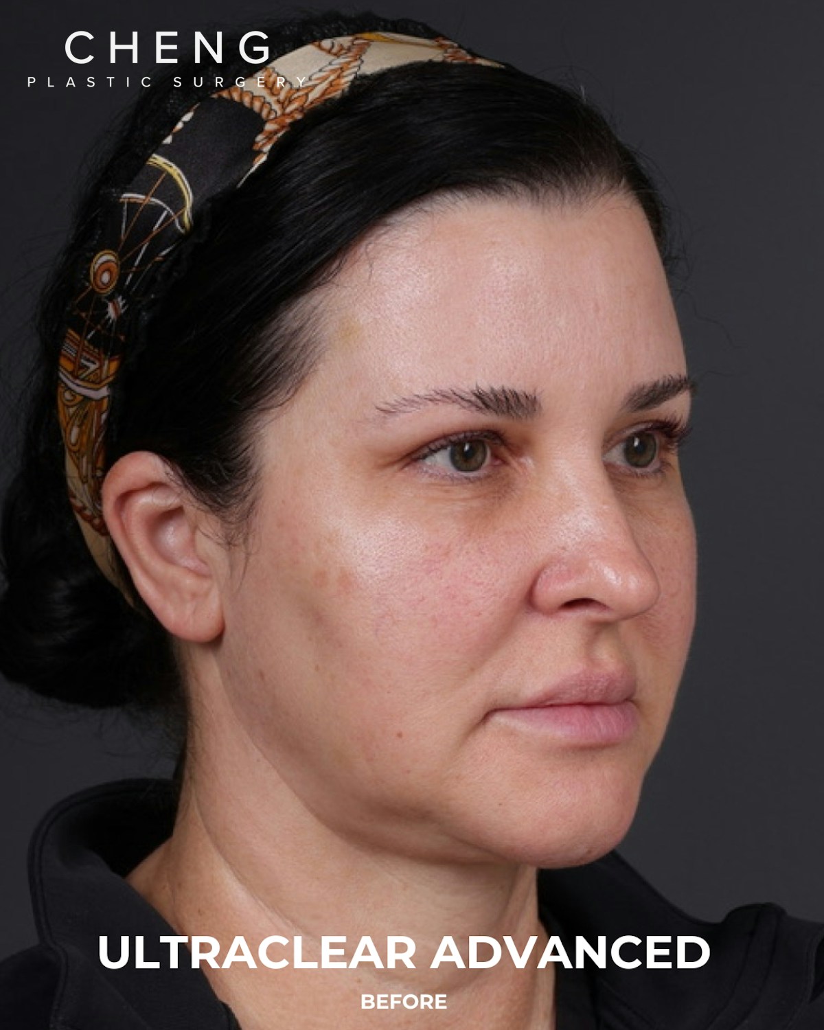 UltraClear Before & After Gallery - Patient 223793 - Image 9
