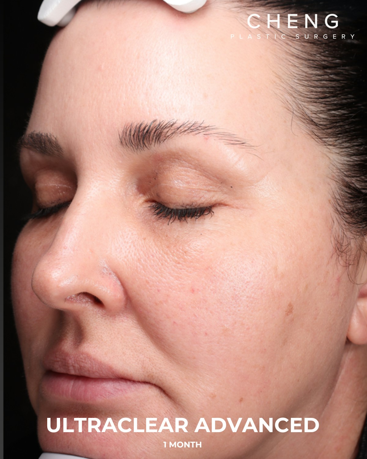 UltraClear Before & After Gallery - Patient 223793 - Image 6