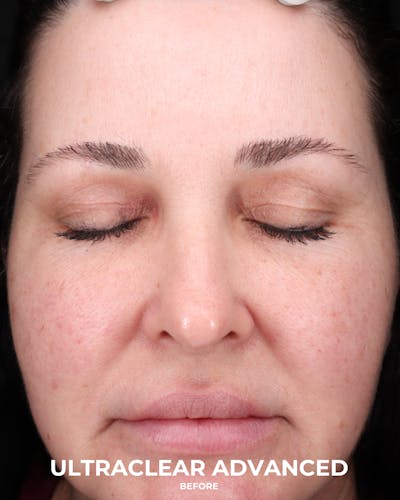UltraClear Before & After Gallery - Patient 223793 - Image 1