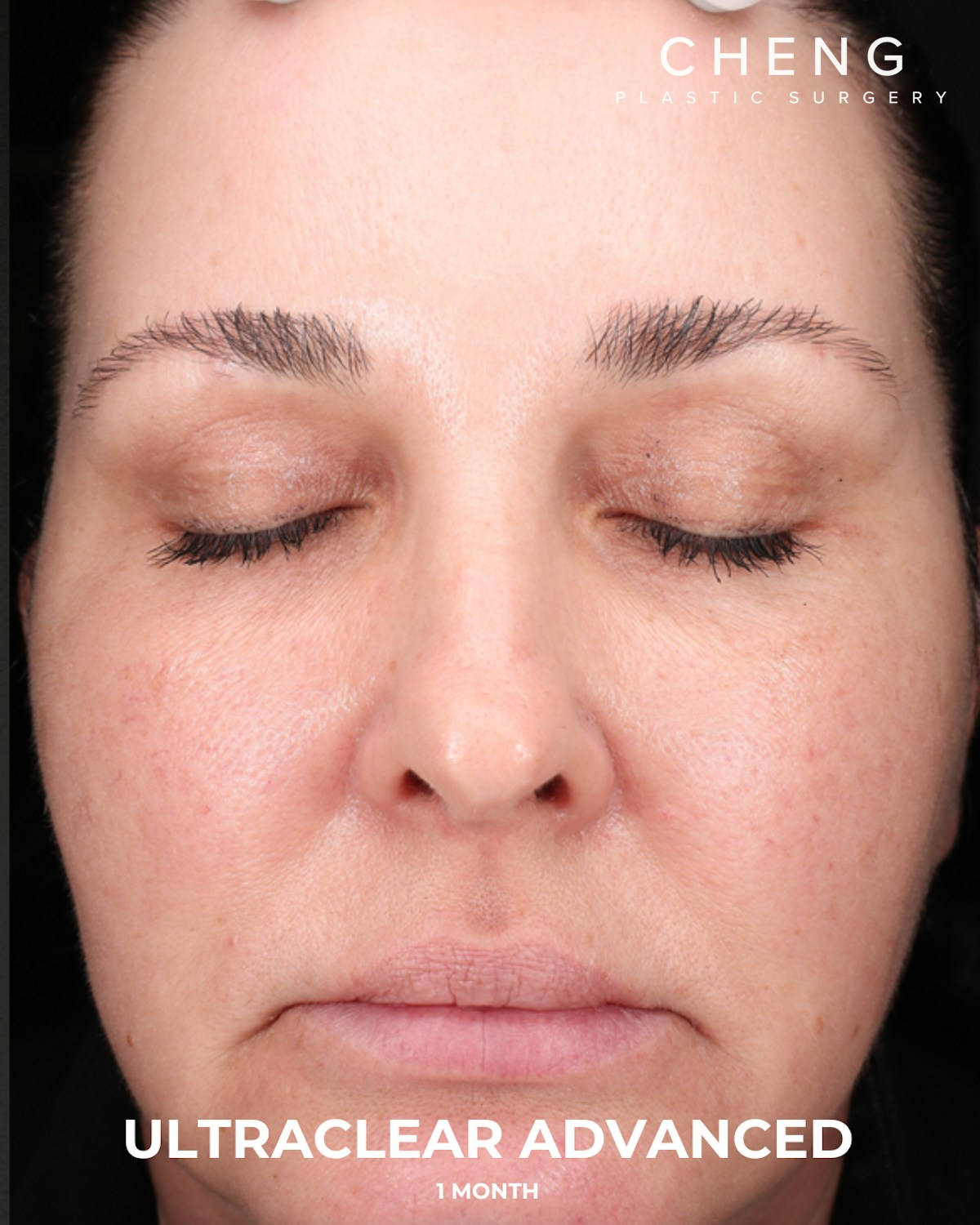 UltraClear Before & After Gallery - Patient 223793 - Image 2
