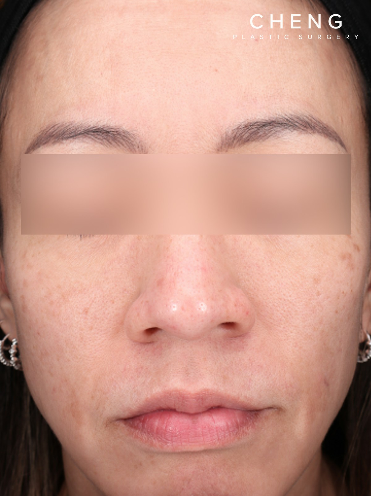 PRF Before & After Gallery - Patient 832565 - Image 2