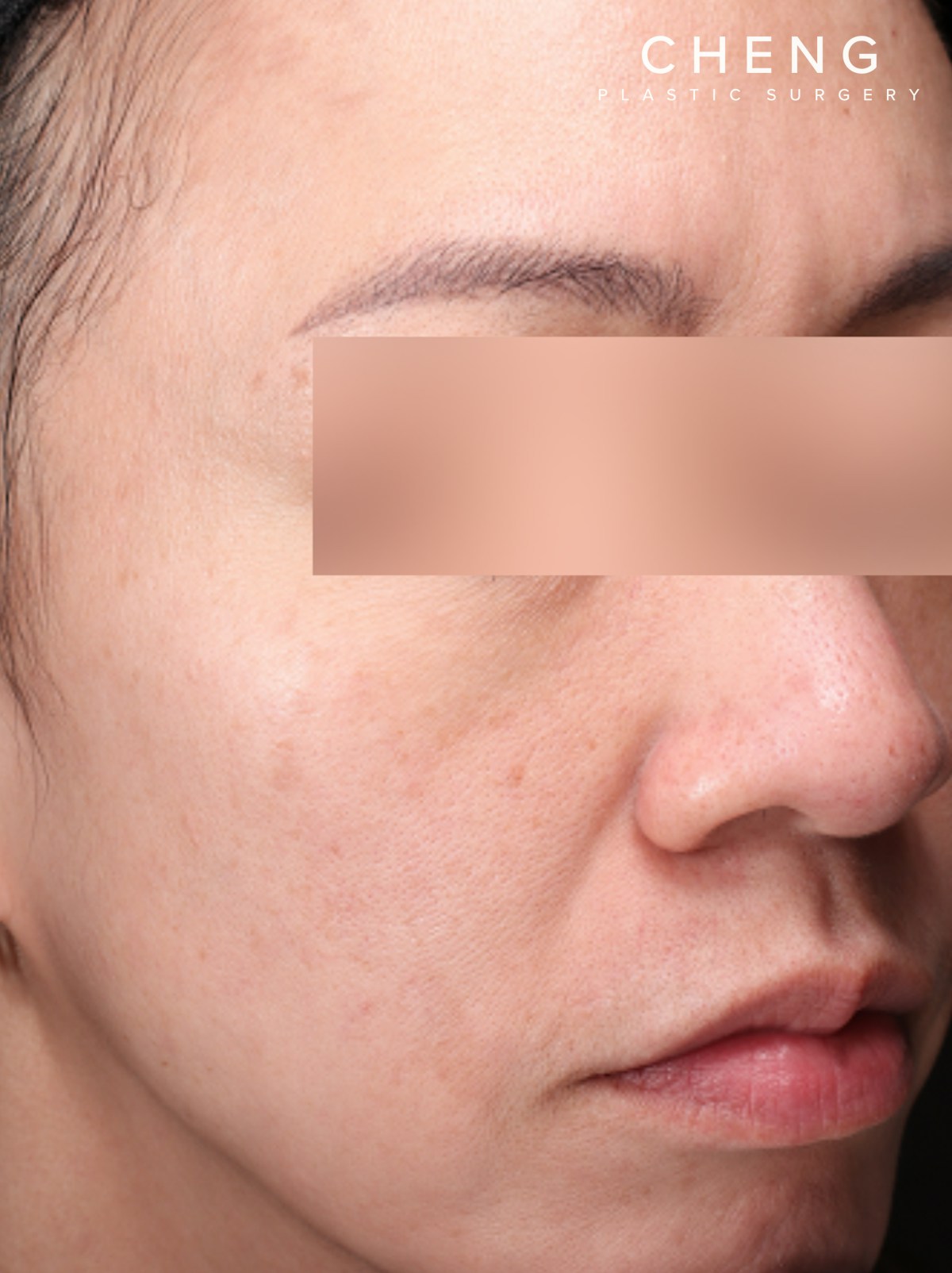 PRF Before & After Gallery - Patient 832565 - Image 4