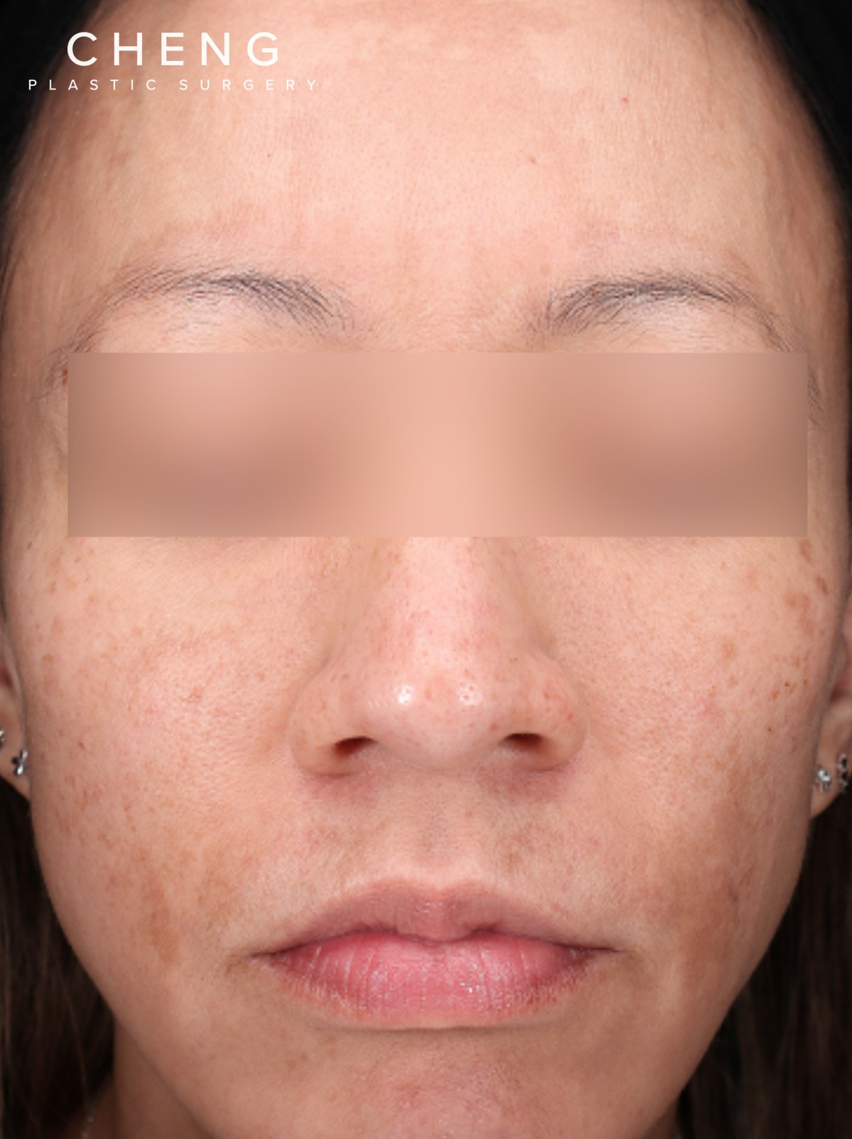 PRF Before & After Gallery - Patient 832565 - Image 1