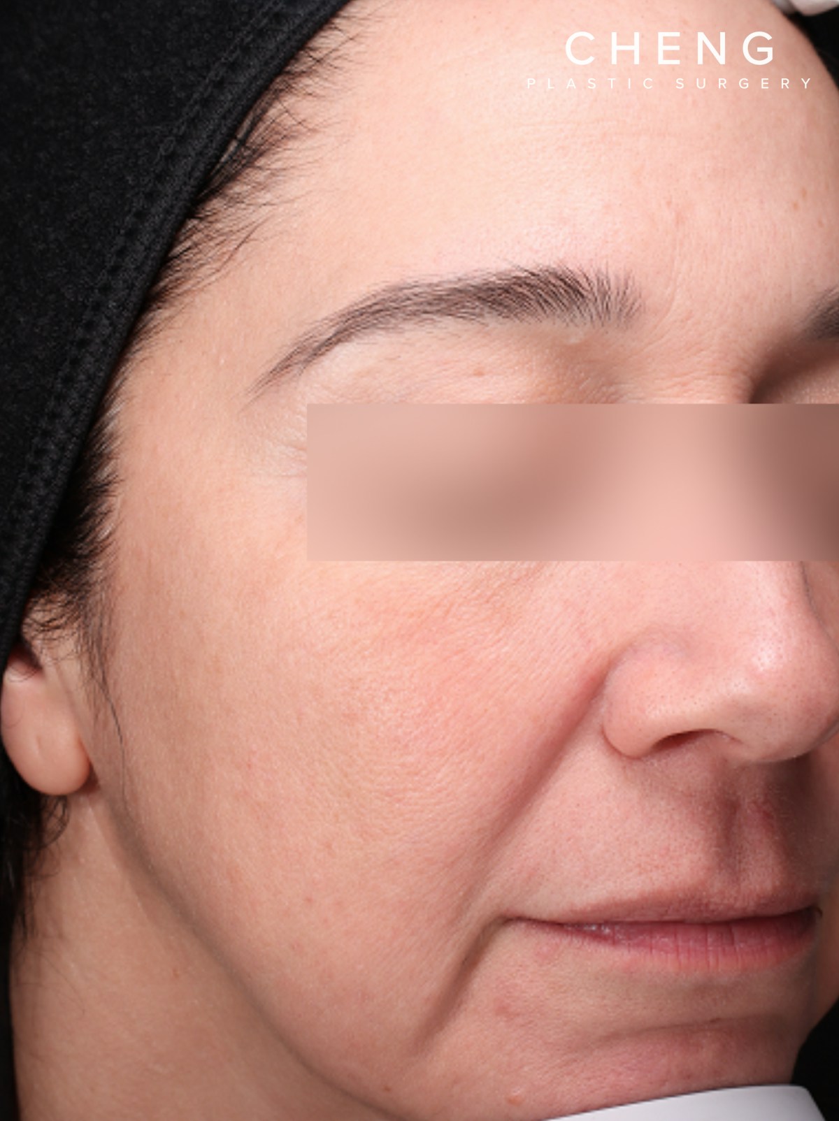 BBL Laser Before & After Gallery - Patient 184315 - Image 4