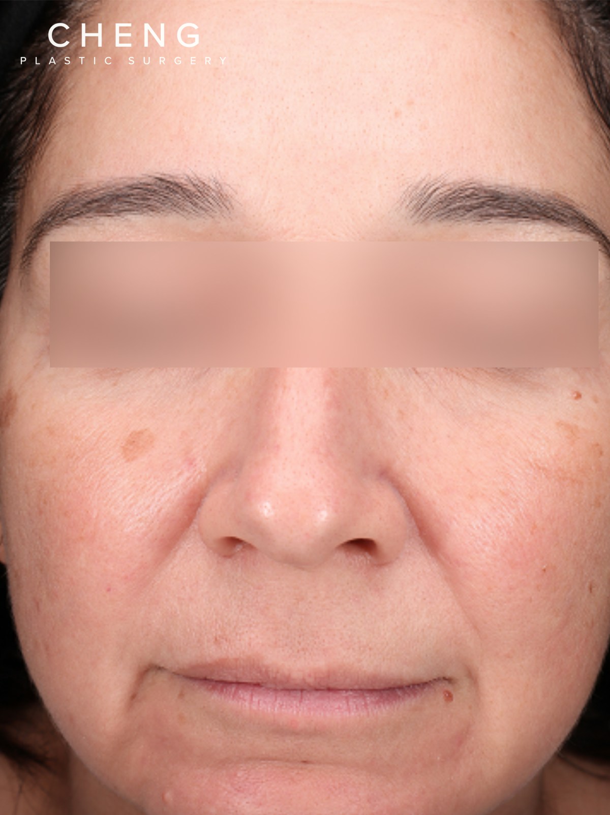 BBL Laser Before & After Gallery - Patient 184315 - Image 1