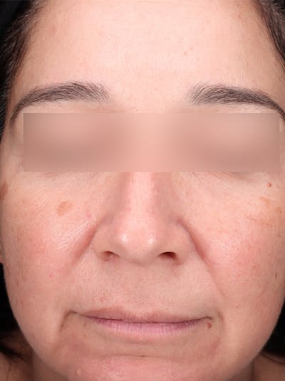 BBL Laser Before & After Gallery - Patient 184315 - Image 1