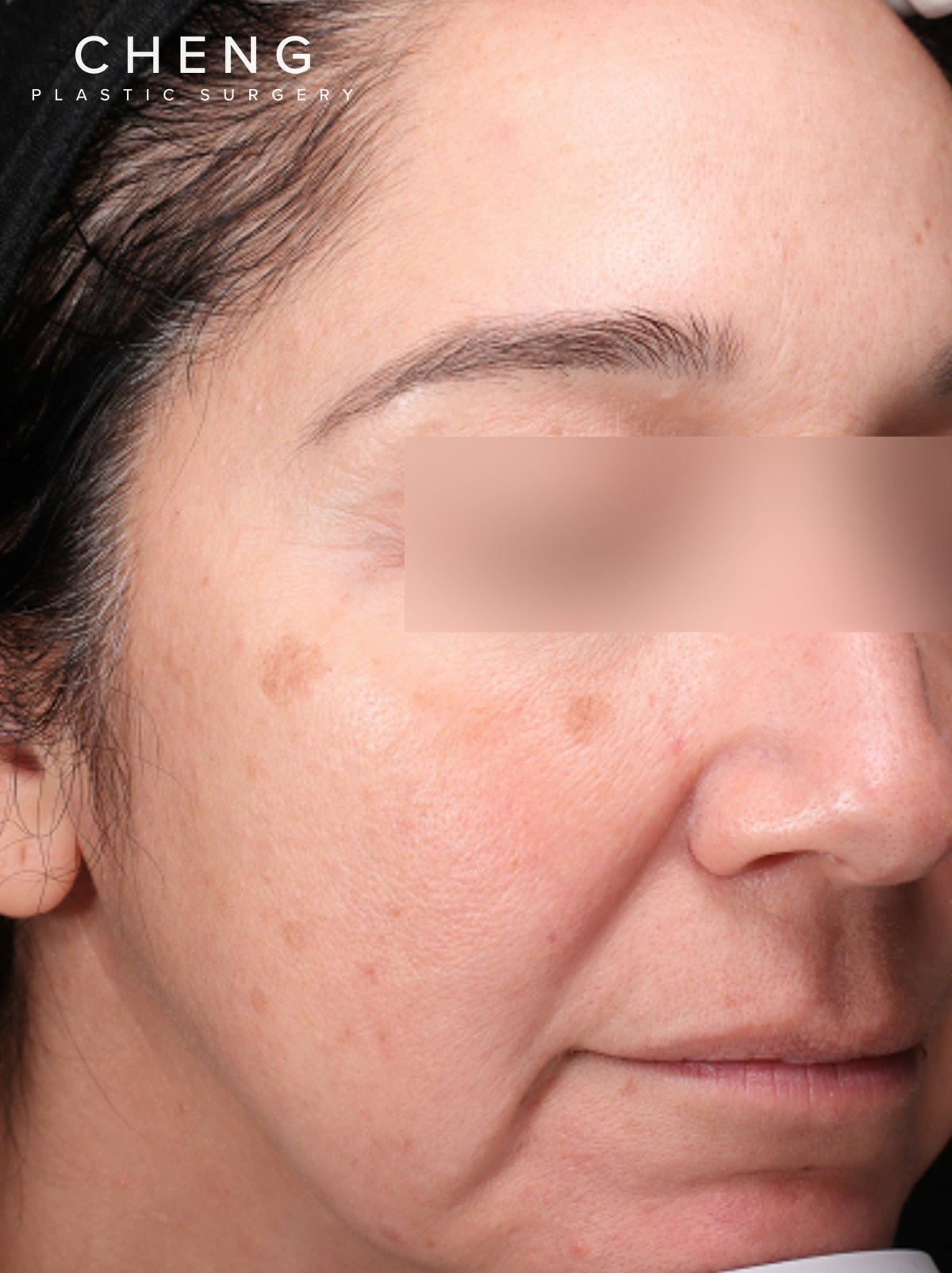 BBL Laser Before & After Gallery - Patient 184315 - Image 3