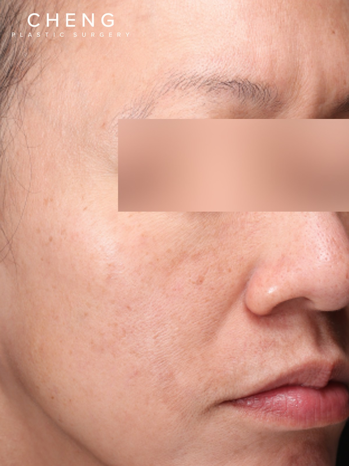 PRF Before & After Gallery - Patient 832565 - Image 3