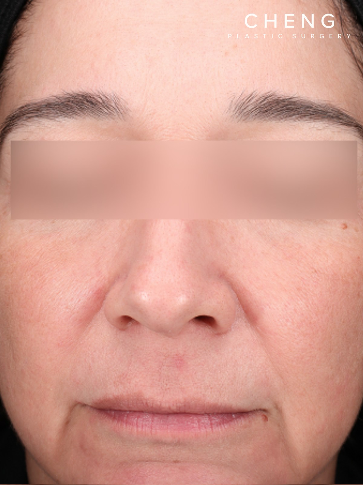 BBL Laser Before & After Gallery - Patient 184315 - Image 2